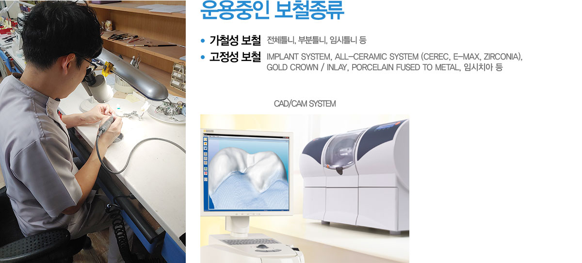  ö
	ö ö - üƲ, κƲ, ӽƲ 
	 ö - IMPLANT SYSTEM, ALL-CERAMIC SYSTEM (CEREC, E-MAX, ZIRCONIA), 
GOLD CROWN / INLAY, PORCELAIN FUSED TO METAL, ӽġ 