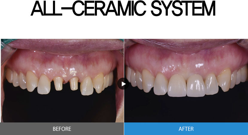 ALL-CERAMIC SYSTEM