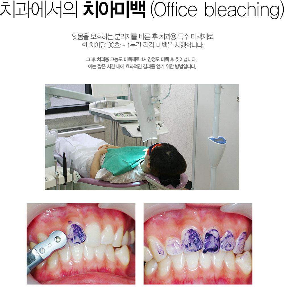 ġ ġƹ̹(Office bleaching)
	ո ȣϴ и ٸ  ġ Ư ̹  ġƴ 3 0 ~1 а  ̹ մϴ.?
	  ġ  ̹ 1ð ̹  ľϴ. ̴ ª ð  ȿ    Դϴ.